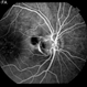 Optic Nerve Pit Optic Nerve Pit